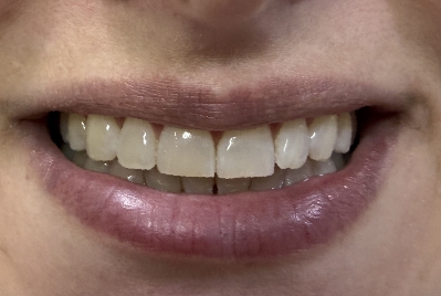 Sorriso antes do clareamento