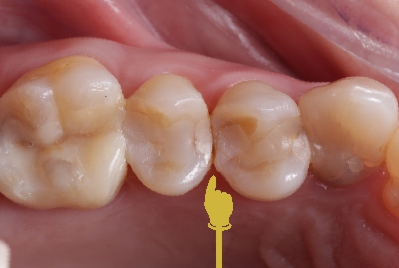 Dente antes da restauração